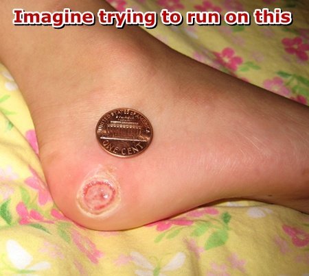 Hand with histiocytosis of the skin