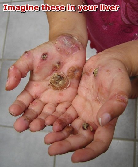 Hand with histiocytosis of the skin